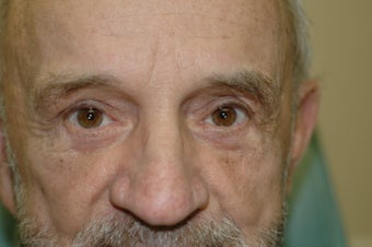 Brow lift
