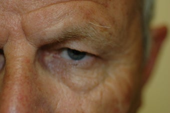 Brow lift