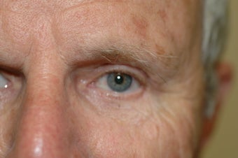 Brow lift
