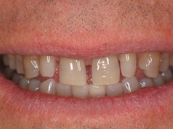 Porcelain Veneers