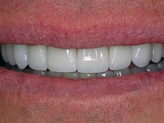 Porcelain Veneers
