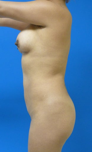 Brazilian Butt Lift