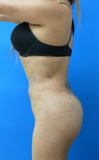Brazilian Butt Lift