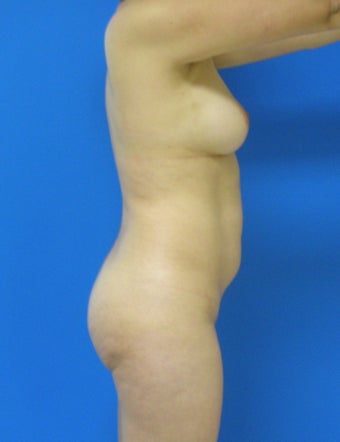 Brazilian Butt Lift