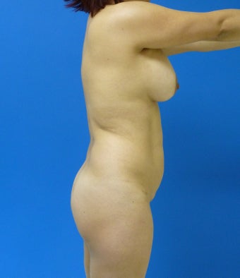 Brazilian Butt Lift
