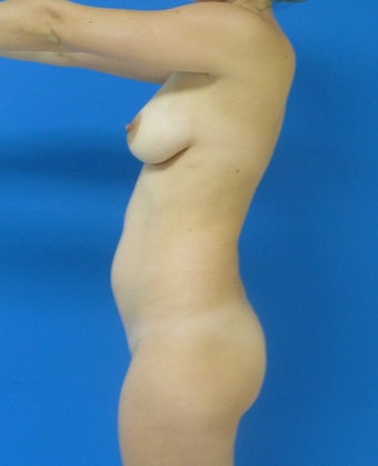 Brazilian Butt Lift