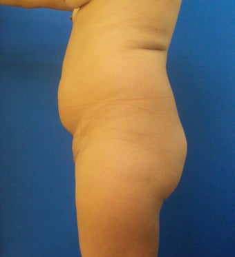 Brazilian Butt Lift