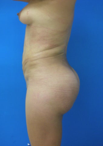 Brazilian Butt Lift