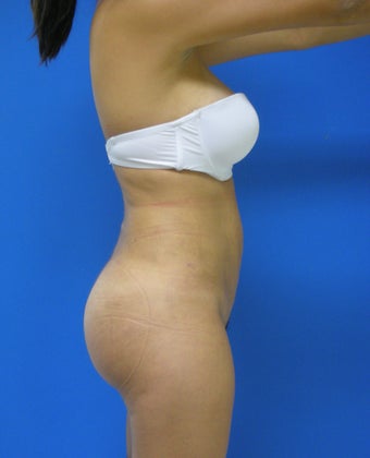 Brazilian Butt Lift