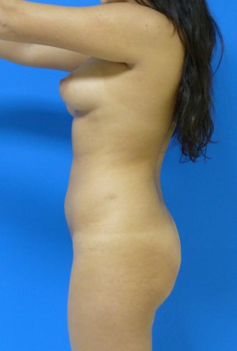 Brazilian Butt Lift