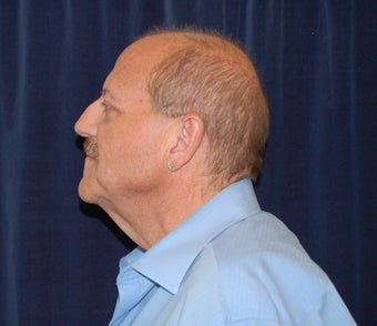 Face Lift and Lower Blepharoplasty