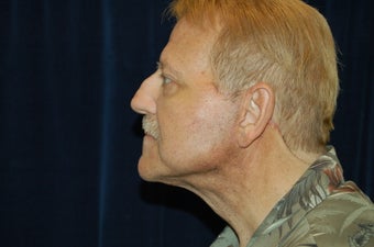 Face Lift and Lower Blepharoplasty