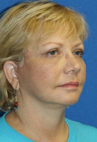 Face Lift