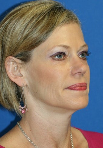 Eye Rejuvenation