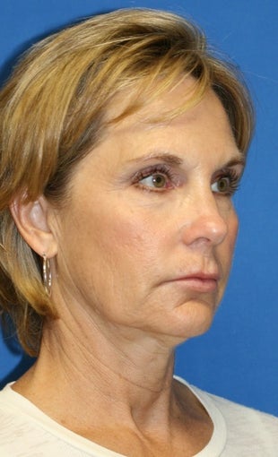 face Lift