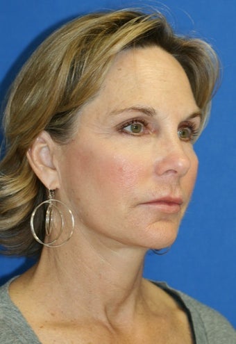face Lift