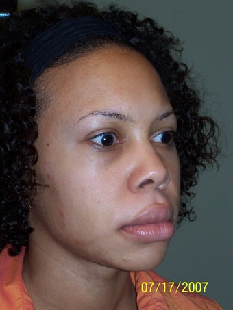 Rhinoplasty