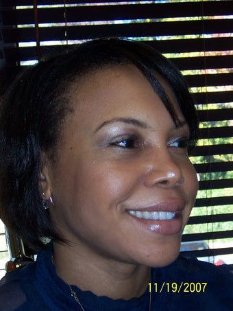 Rhinoplasty