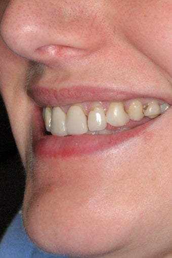 Replacement Porcelain Veneers