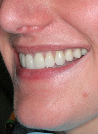 Replacement Porcelain Veneers