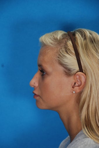 Rhinoplasty (nose job, nasal surgery)