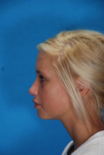 Rhinoplasty (nose job, nasal surgery)