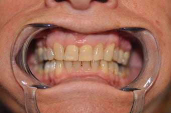 Invisalign to replace a HIDEOUS crown/tooth