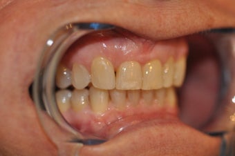 Invisalign to replace a HIDEOUS crown/tooth