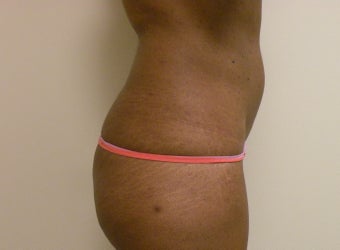 Liposuction 
