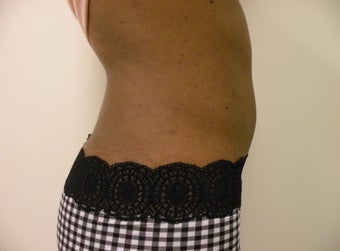 Liposuction 
