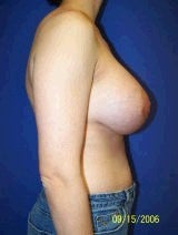 Revision Breast Surgery