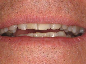 Upper and Lower Veneers