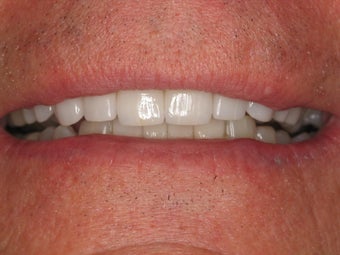 Upper and Lower Veneers