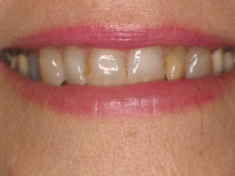 Zoom Whitening; Porcelain Veneers; Porcelain Crowns