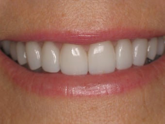 Zoom Whitening; Porcelain Veneers; Porcelain Crowns