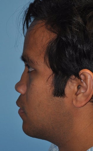 Rhinoplasty-Asian