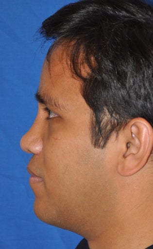 Rhinoplasty-Asian