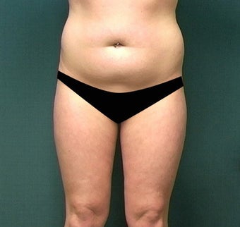 Liposuction