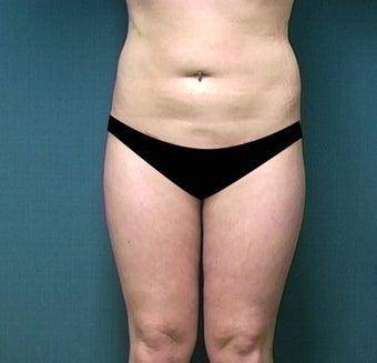 Liposuction
