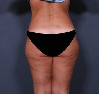 Liposuction