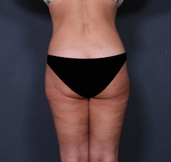 Liposuction