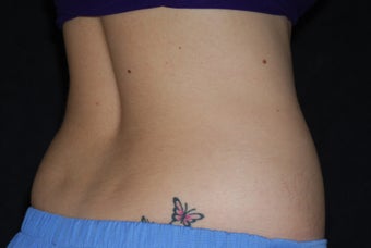 CoolSculpting/flanks