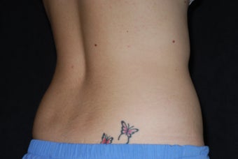 CoolSculpting/flanks