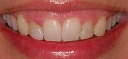 Botox for a gummy smile