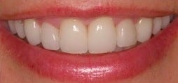 Botox for a gummy smile