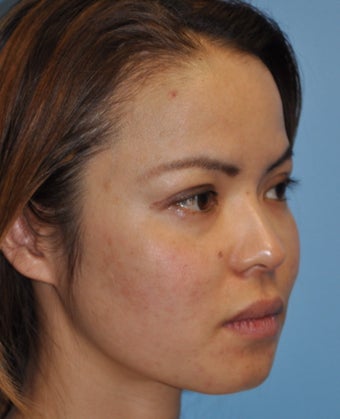 Rhinoplasty-Asian