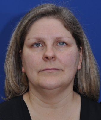 Browlift, submental liposuction
