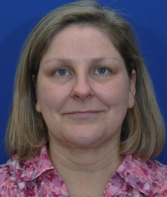 Browlift, submental liposuction