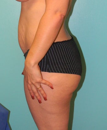 Brazilian Butt Lift- Fat transfer