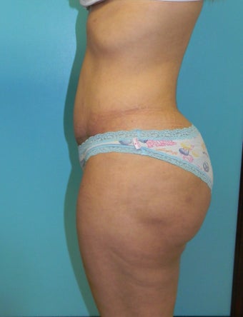 Brazilian Butt Lift- Fat transfer
